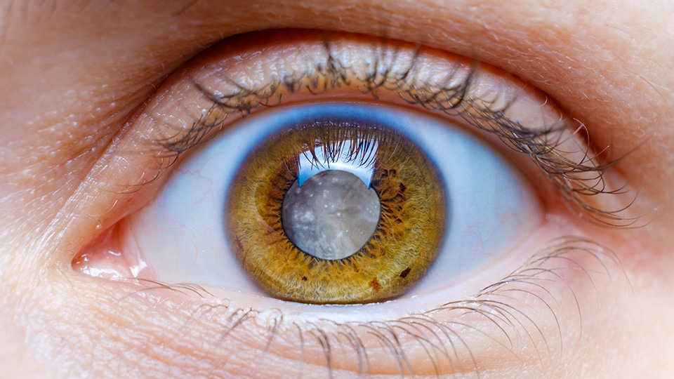mkg cataract service graphic